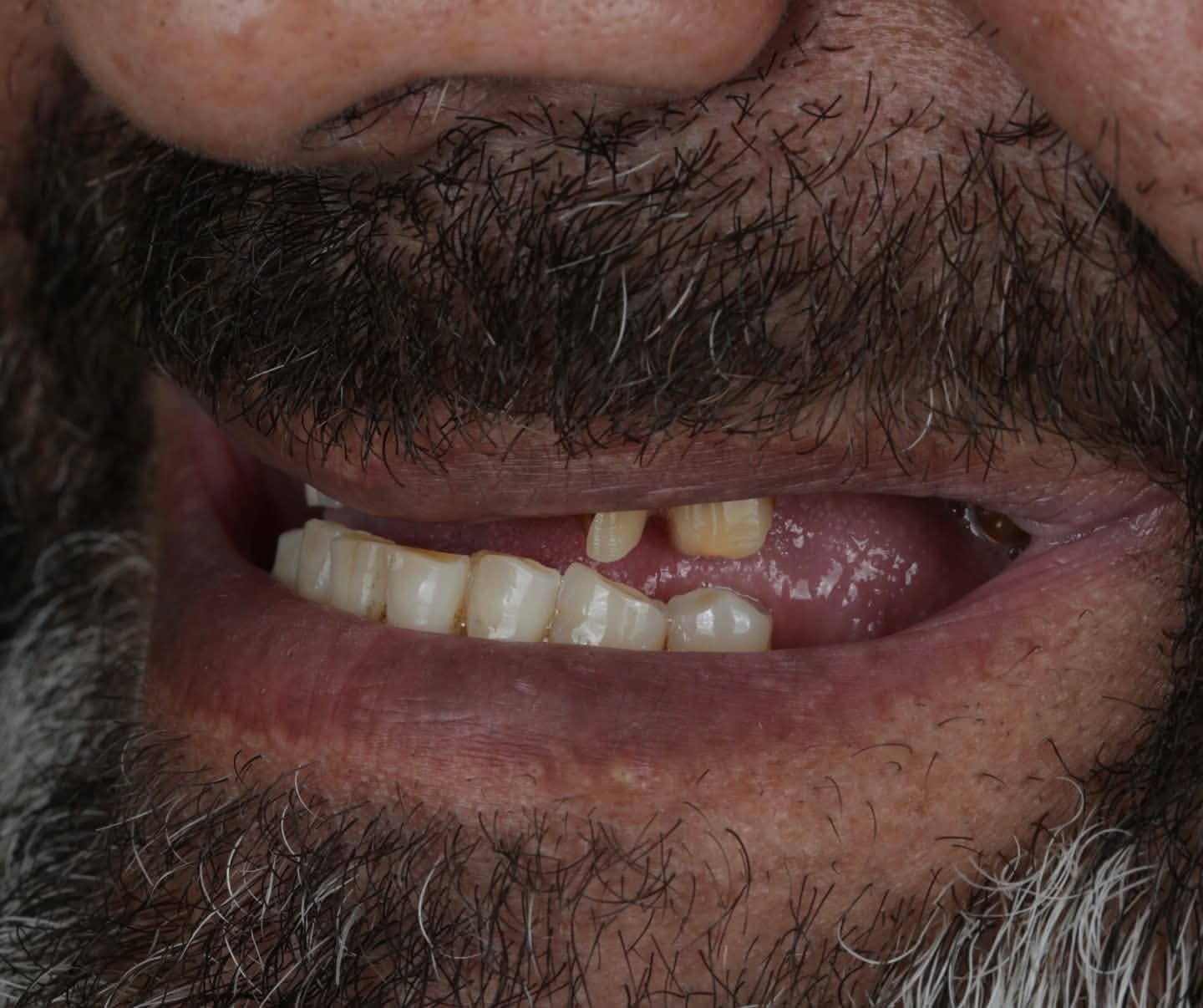 Dental Implants Before