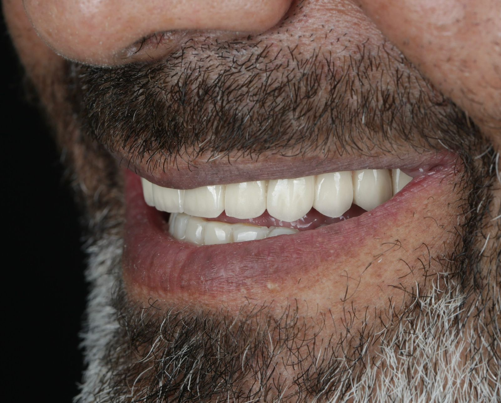 Dental Implants After