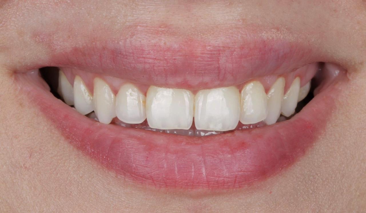 Crown Lengthening After