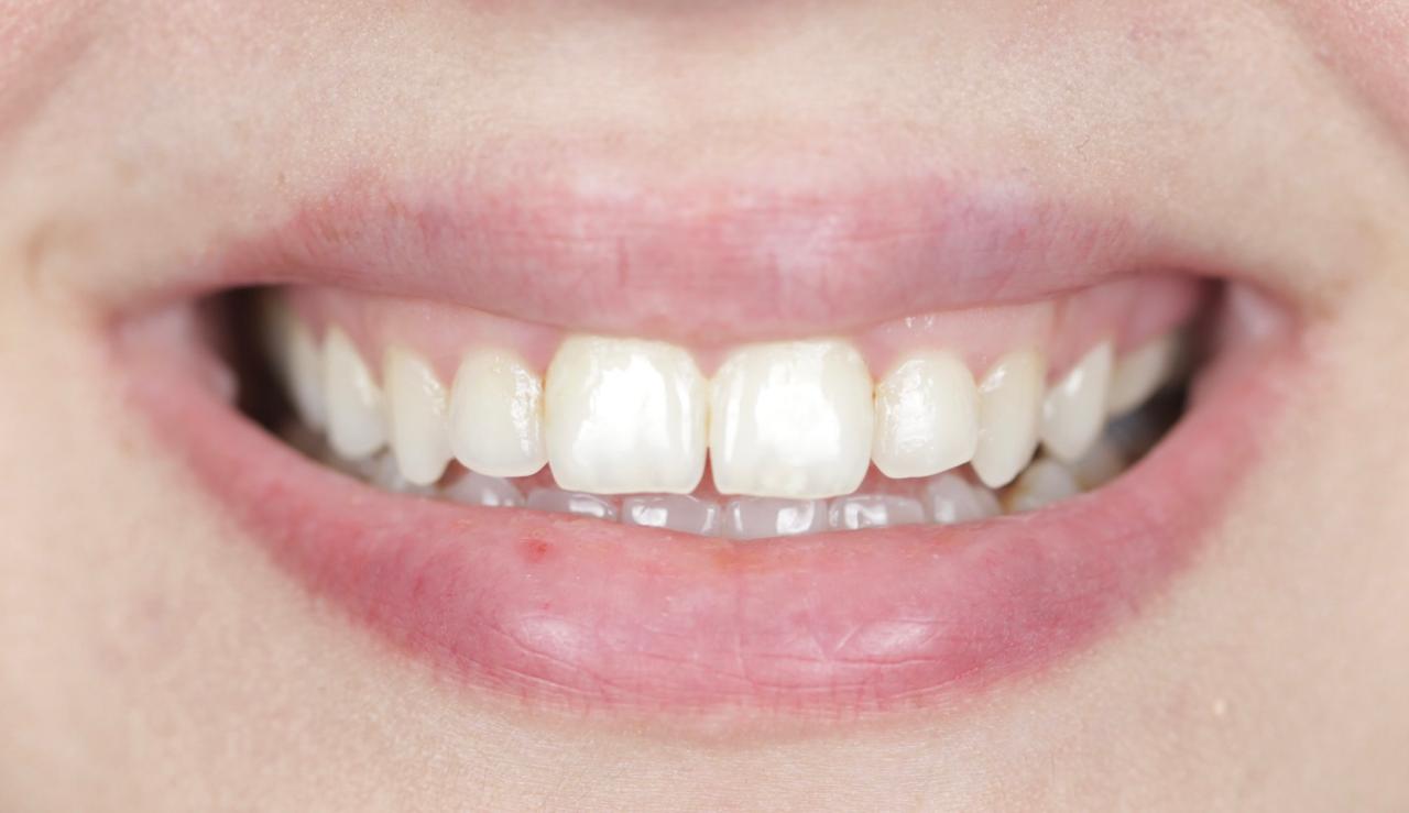 Crown Lengthening Before